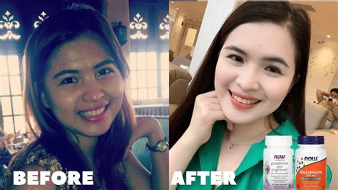 Glutathione Before and After Results .